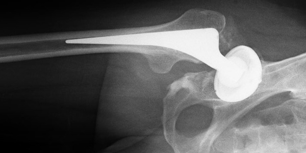 Röntgenaufnahme einer Hüftgelenk-Endoprothese